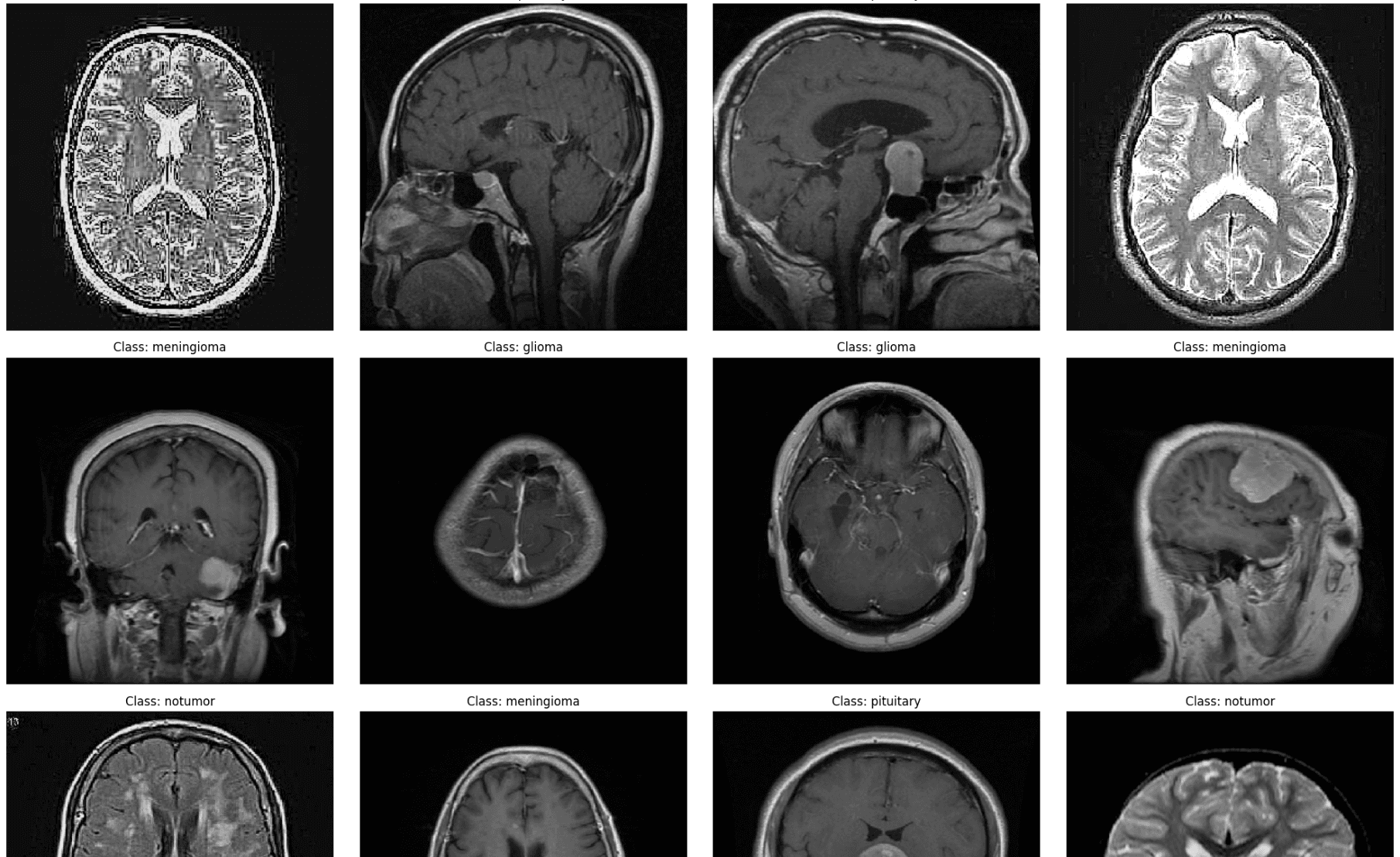 Brain Tumor Classification Model